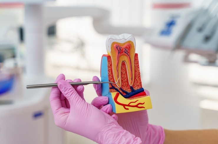 root canal