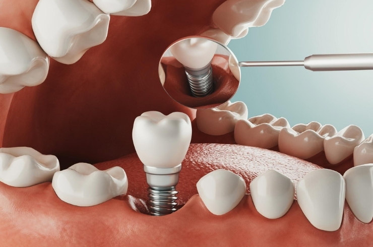 dental implant